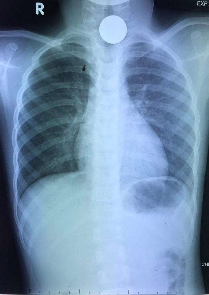 Bé gái 6 tuổi suýt tắt thở vì nuốt phải đồng xu