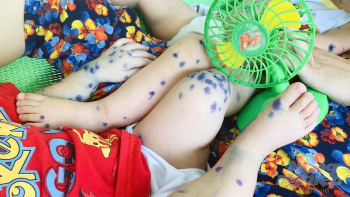 Bốn trẻ tử vong vì tay chân miệng, có dấu hiệu này cần đưa đi viện ngay