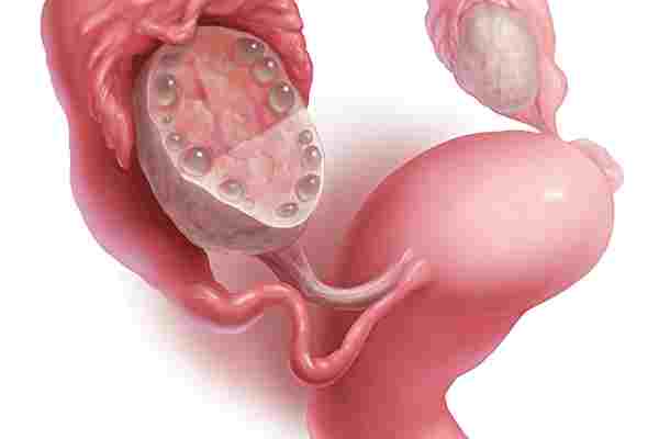 Buồng trứng đa nang có thai được không?