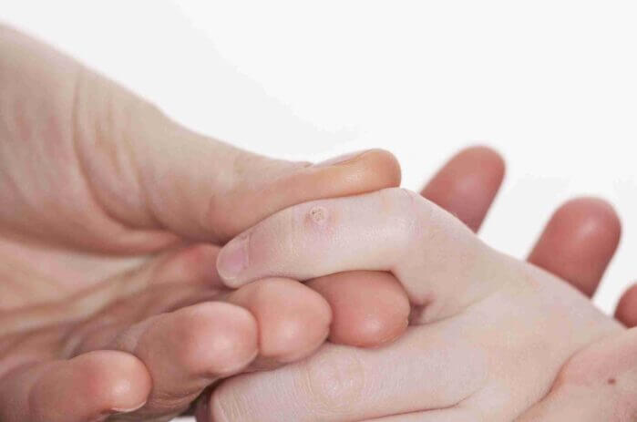 Các nguyên nhân và điều trị mụn cóc thông thường