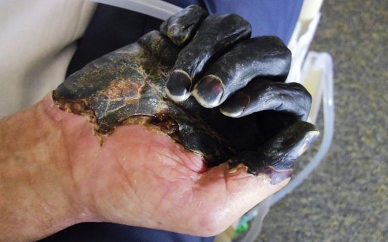 Cái chết đen là gì? Bệnh dịch hạch là gì?