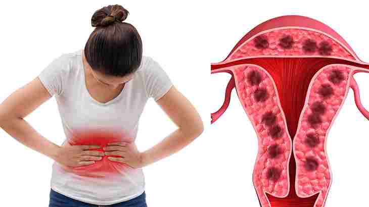 Lạc nội mạc tử cung là gì và nguyên nhân do đâu?