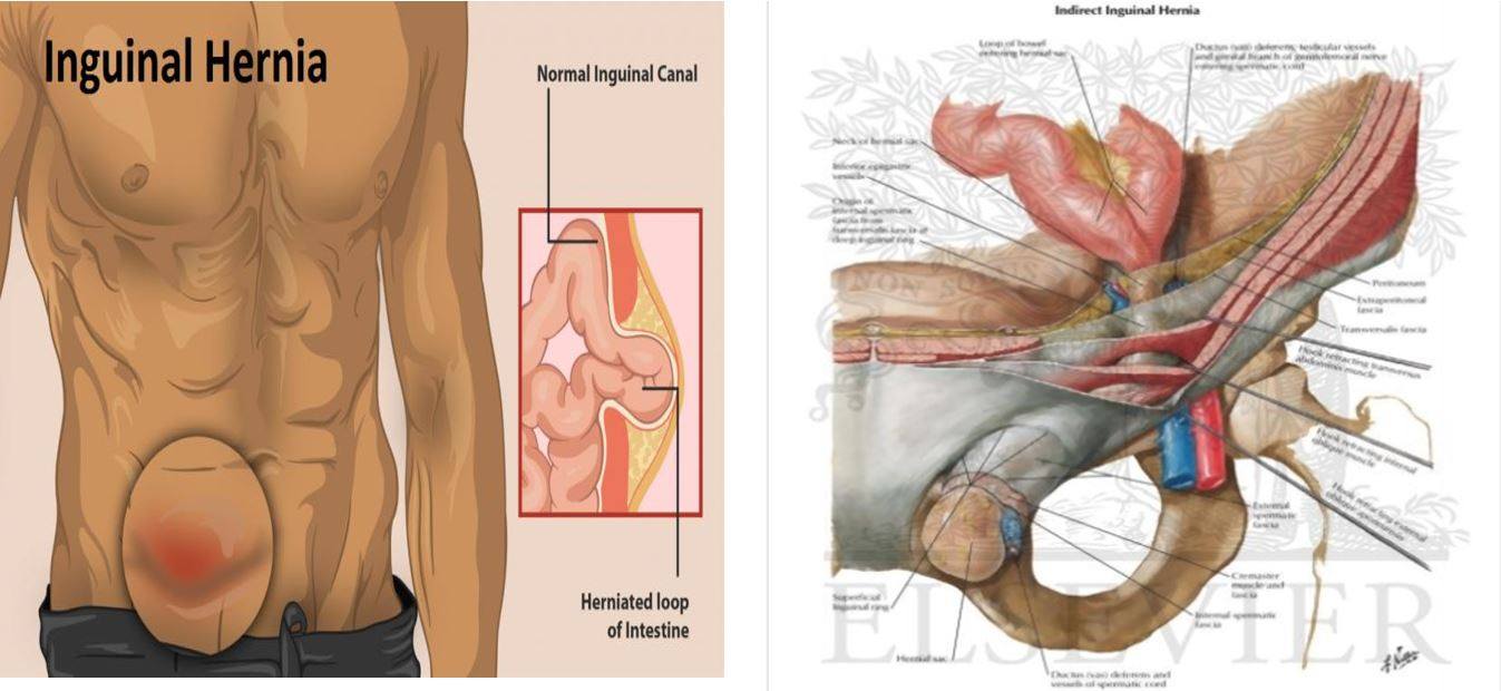 Nguyên nhân triệu chứng và cách điều trị thoát vị bẹn