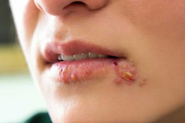 Những dấu hiệu và triệu chứng của bệnh herpes simplex