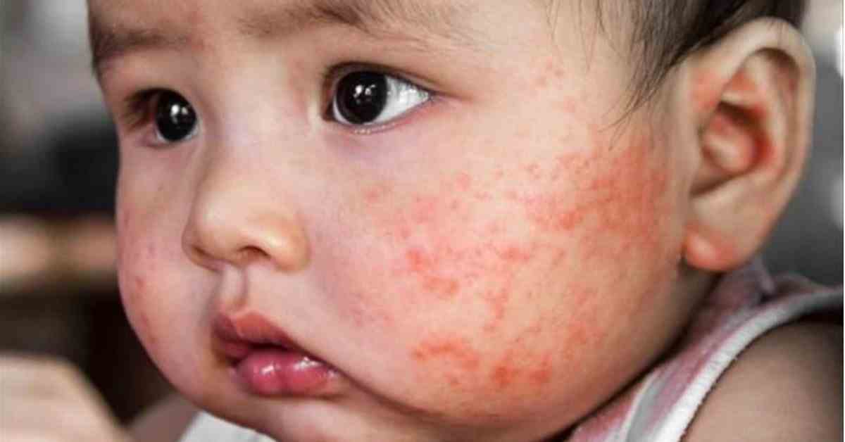 Phải làm gì khi trẻ bị chàm sữa?