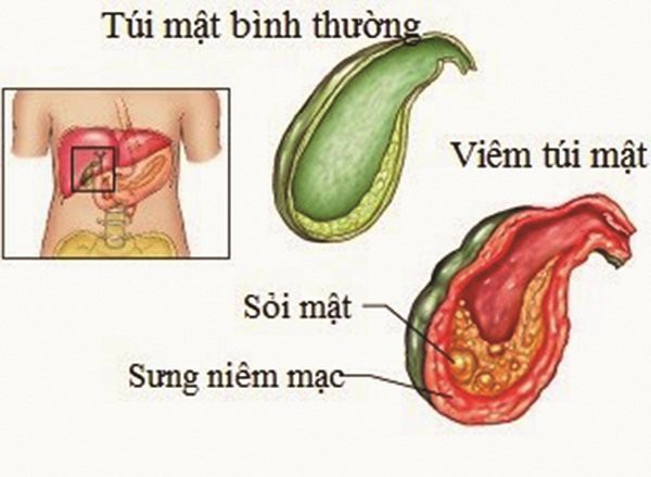 13 tuổi đã bị sỏi mật, bố mẹ bàng hoàng khi biết thấy nguyên nhân