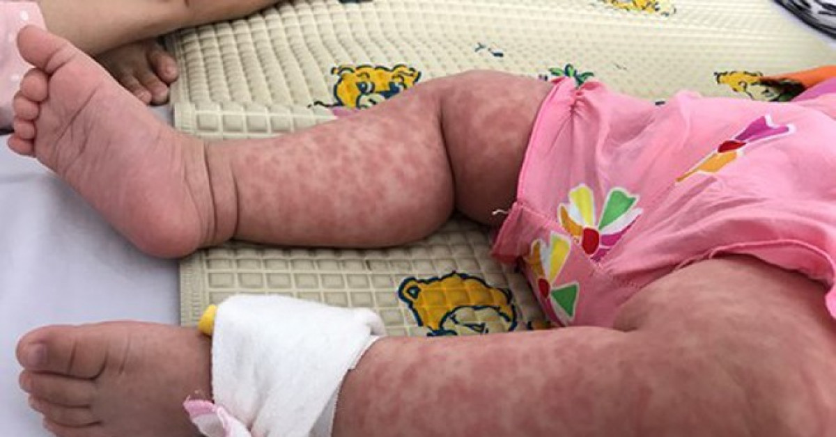 9 ca tử vong do sốt xuất huyết tại Thành Phố Hồ Chí Minh