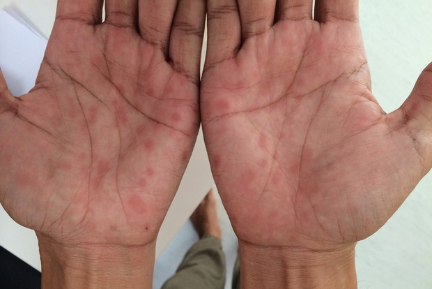 Bé trai 13 tuổi mắc bệnh giang mai do con đường lây nhiễm nào?