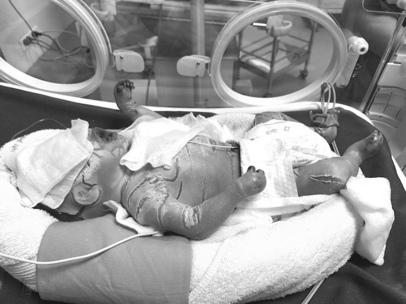 Bé trai vừa chào đời đã bị rạn nứt da toàn thân