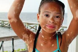 Bệnh bạch cầu: nguyên nhân, triệu chứng, cách điều trị