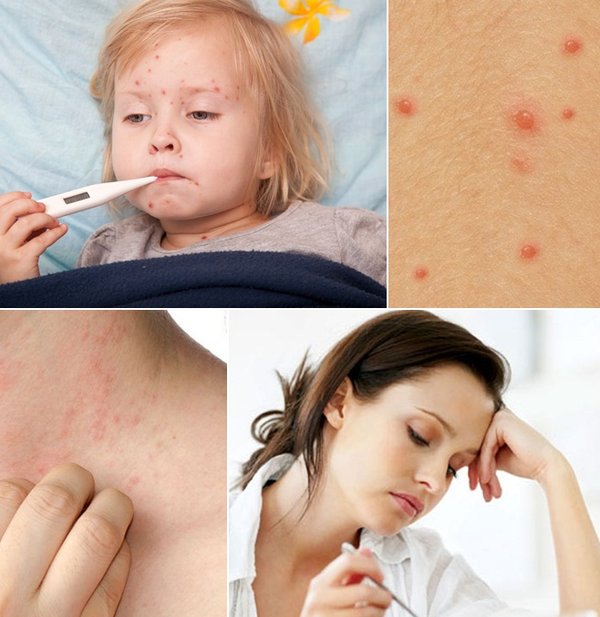 Bệnh bỏng rạ có nguy hiểm không? Cách chăm sóc và điều trị bệnh như thế nào?