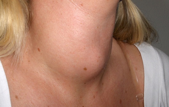 Bệnh bướu cổ có nguy hiểm không, cách điều trị thế nào?