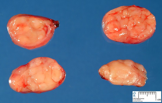 Bệnh castleman là gì, có phải bệnh ung thư không?