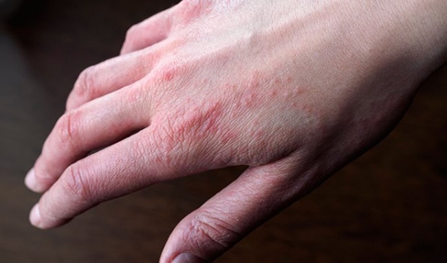 Bệnh eczema là gì? Bệnh có chữa khỏi không?