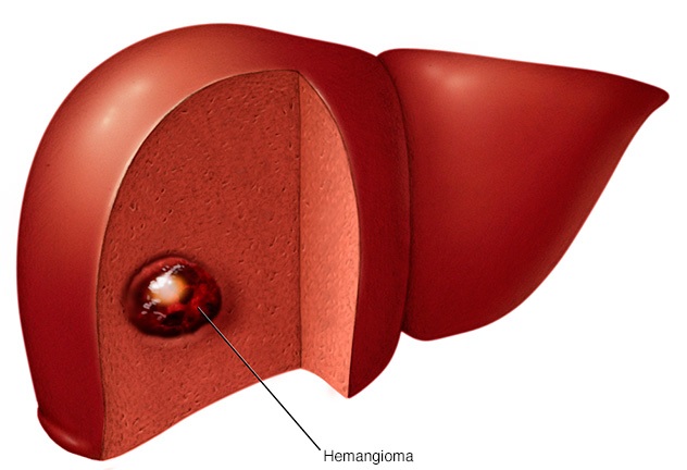 Bệnh Hemangioma gan có những phương pháp chẩn đoán và điều trị như thế nào?