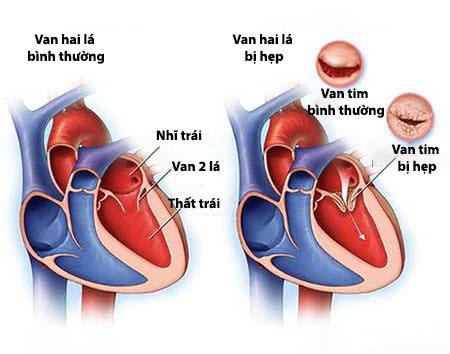 Bệnh hẹp van hai lá có nguy hiểm không? Phương pháp nào để điều trị?