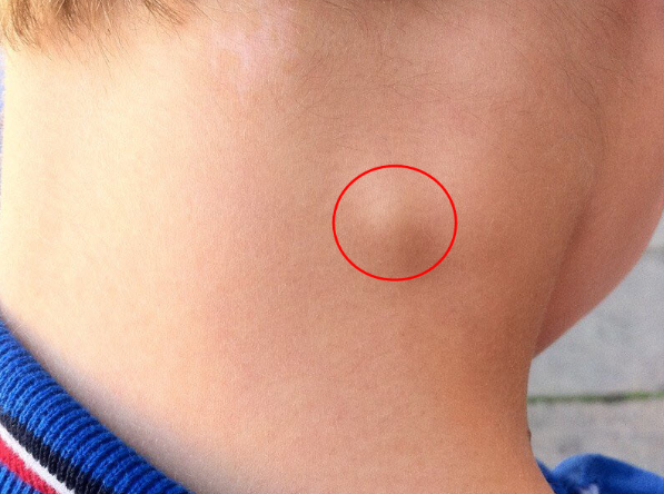 Bệnh lao hạch cổ có lây không? Có những phương pháp nào được dùng trong điều trị bệnh?