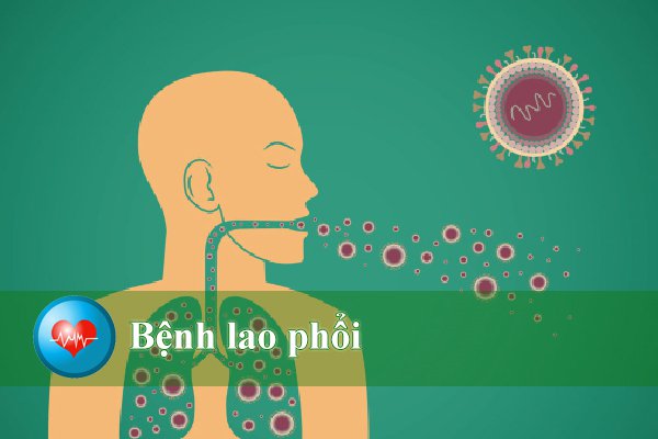 Bệnh lao phổi và những triệu chứng để nhận biết