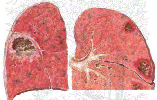 Bệnh phổi kẽ: triệu chứng, điều trị, phòng tránh