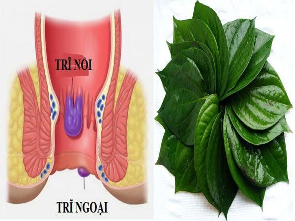 Bệnh trĩ sau sinh là gì? Hướng dẫn các mẹo chữa bệnh trĩ sau sinh