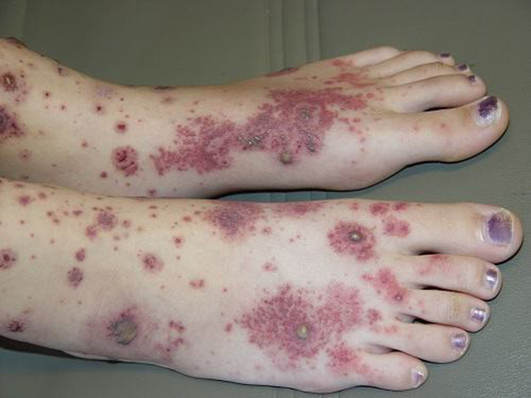 Bệnh viêm mao mạch dị ứng: Nguyên nhân, triệu chứng, cách chẩn đoán và điều trị bệnh