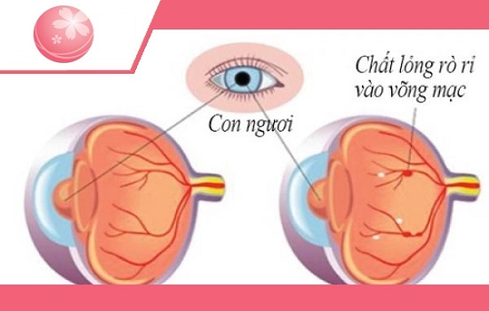 Bệnh võng mạc tiểu đường có mổ mắt được không?