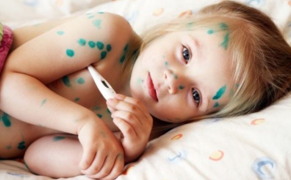 Bị thủy đậu, có nên tự xử lý tại nhà?