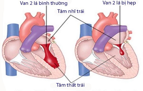 Biến chứng đáng sợ của bệnh hẹp van hai lá