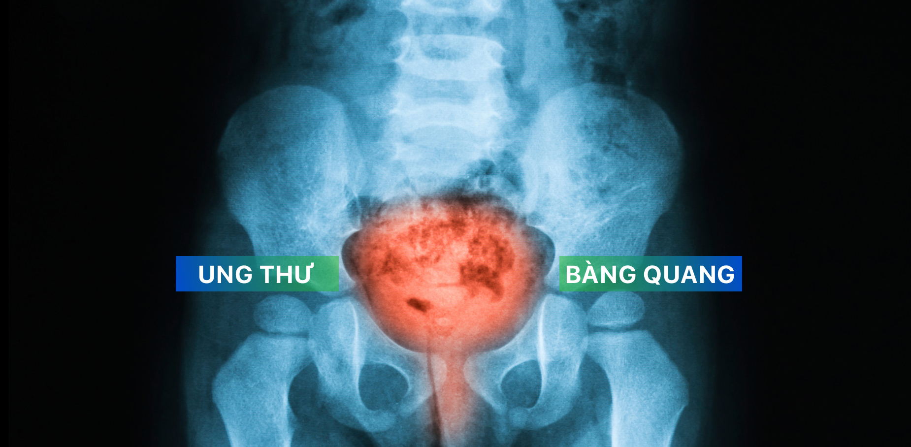 Các biện pháp điều trị và chẩn đoán bệnh ung thư bàng quang là gì?