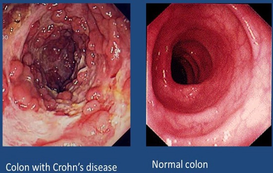 Các cách điều trị bệnh Crohn (viêm ruột) tại nhà hiệu quả mà vô hại