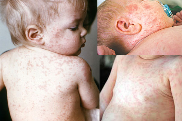 Các loại bệnh ngoài da mà trẻ nhỏ thường hay mắc phải