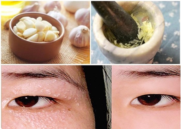 Cách chữa mụn thịt quanh mắt bằng phương pháp dân gian ít tốn kém