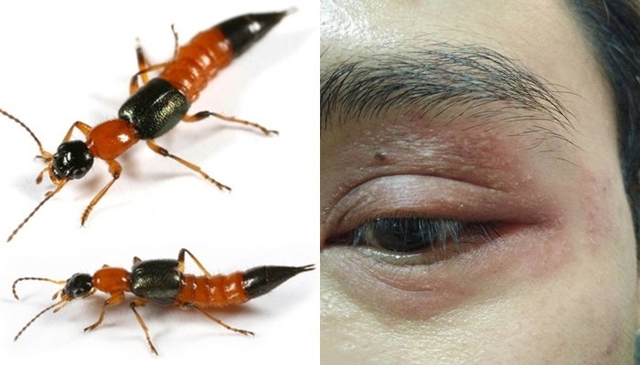 Cách nhận biết và xử lý tổn thương do kiến ba khoang gây ra