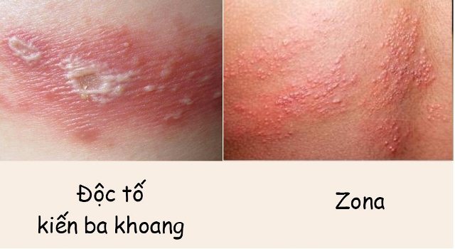 Cách phân biệt với vết kiến ba khoang đốt với bệnh Zona
