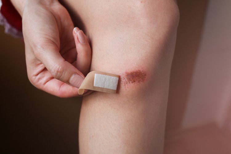 Cách xử lý vết trầy chân do bị té xe nhanh chóng lành và không để lại sẹo