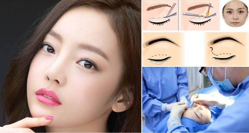 Cắt mí mắt bao lâu hết sưng, lành, đẹp và tự nhiên?