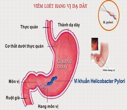 Có cách nào để chữa viêm loét hang vị dạ dày? Người bệnh nên ăn gì tốt nhất?