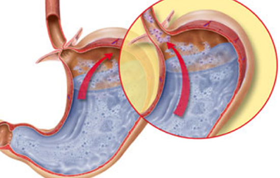 Co thắt thực quản được chẩn đoán và điều trị bằng cách nào?