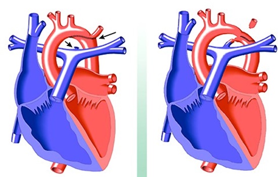 Còn ống động mạch (pda) – bệnh lý nguy hiểm ở trẻ sinh non