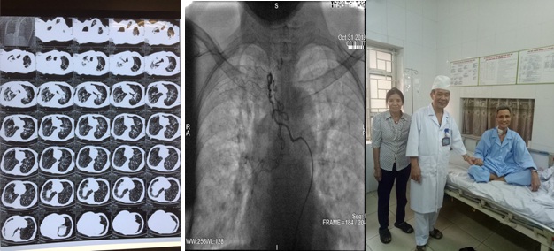 Cứu sống ông cụ bị ho ra máu sét đánh, căn bệnh có tỉ lệ tử vong gần như 100%