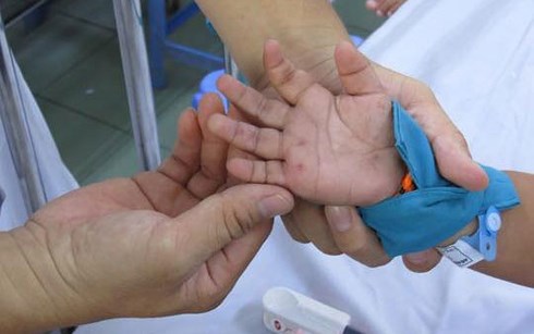 Đà Nẵng đã thành lập  khu cách ly cho người mắc bệnh chân tay miệng