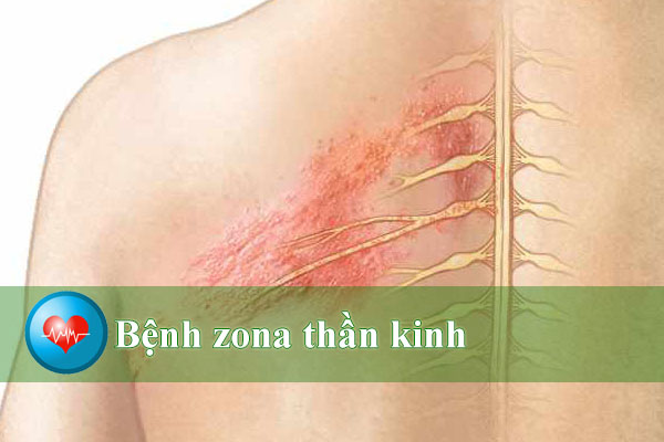Biểu hiện của bệnh Zona thần kinh: Những nguyên nhân và cách điều trị