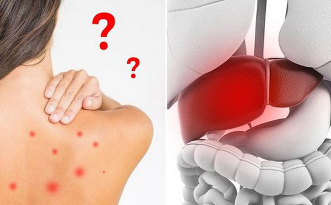 Dấu hiệu nhận biết suy giảm chức năng gan và các lưu ý khi điều trị bệnh