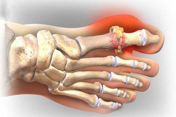 Đẩy lùi bệnh gout bằng chế độ ăn uống, sinh hoạt hợp lý