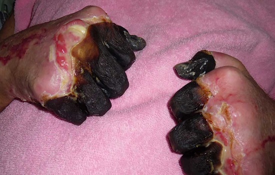 Dịch hạch – “căn bệnh thế kỉ” không thể biến mất