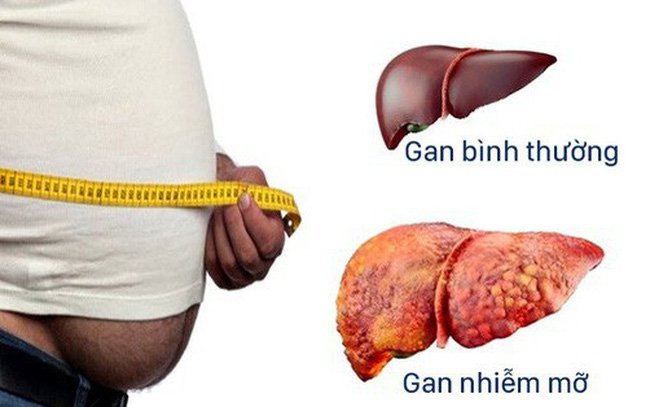 Điều trị hiệu quả bệnh gan nhiễm mỡ không do rượu