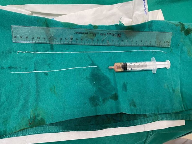 Gắp những con giun dài tới 60cm ở bắp tay 1 thanh niên ở Yên Bái