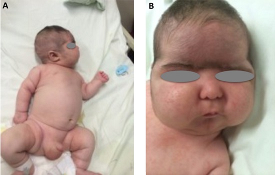 Hội chứng Cushing có điều trị được không?