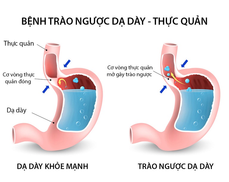 Khi xuất hiện các dấu hiệu trào ngược dạ dày thực quản cần điều trị theo phương pháp nào?