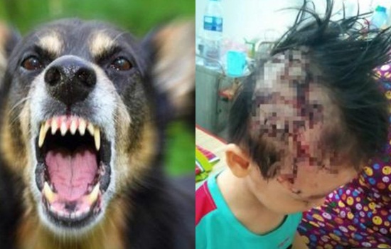 Kinh hoàng trước hình ảnh bé trai 5 tuổi bị rách da đầu do chó béc-giê cắn
